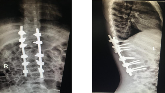遵医附院小儿矫形外科成功为9岁患儿完成脊柱后凸畸形手术
