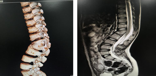 遵医附院小儿矫形外科成功为9岁患儿完成脊柱后凸畸形手术