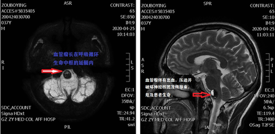 遵医附院神经外科团队成功完成贵州省首例延髓海绵状血管瘤手术
