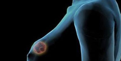 专家：晚期乳腺癌治疗策略发展系统化 ，渐渐成为可控的慢病