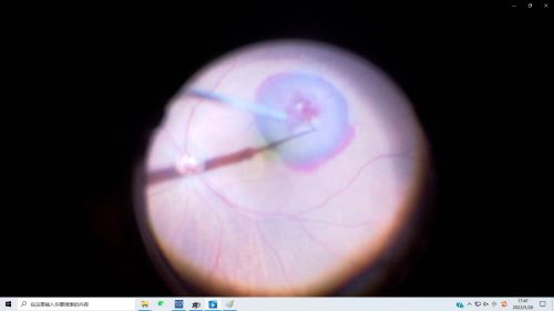 41G超微针头视网膜下注射tPA