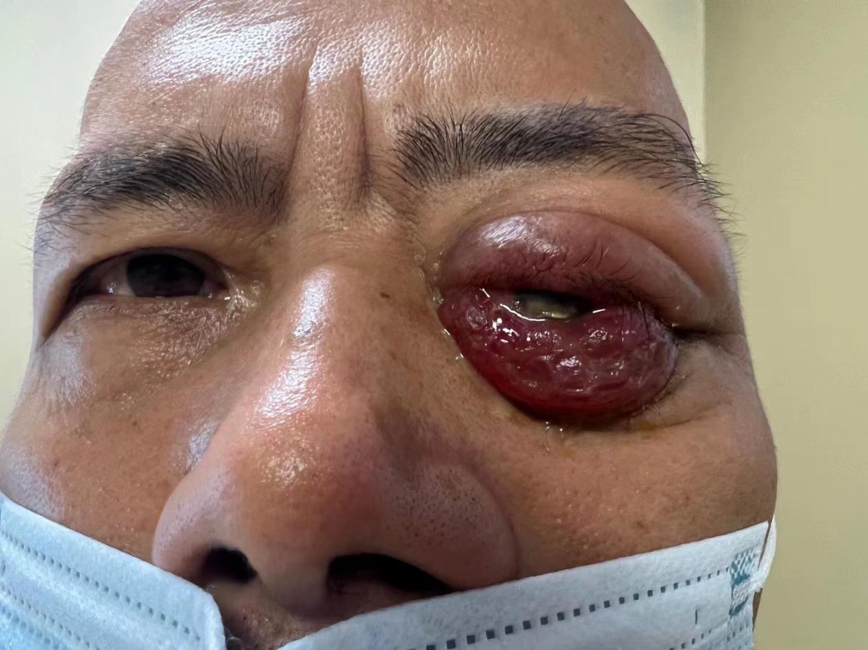 龙岩大叔眼眶肿物拖了10年发生恶变，比眼球还大，摘除手术犹如拆弹