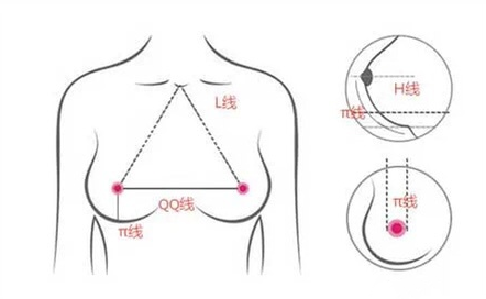 北京煤医副主任医师王驰：假体隆胸如何获得更加良好的乳房形态？