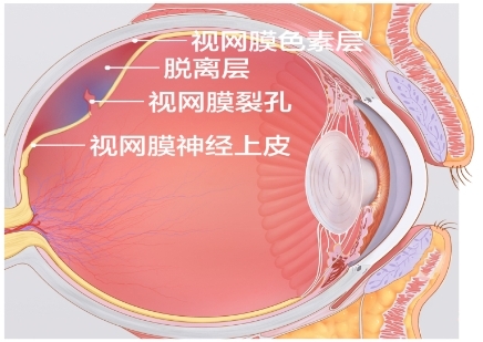 艾维眼科眼底病科 玻璃体积血并视网膜脱离病案实例
